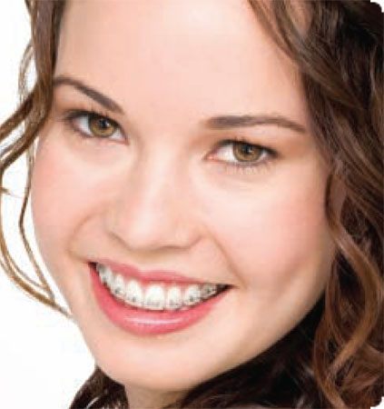 Dental Braces For Adults 45