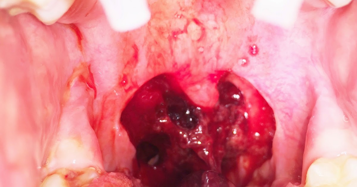 Tonsillectomy and Uvulopalatopharyngoplasty (UPPP)