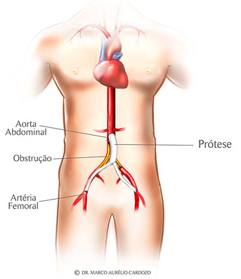 Cirurgia vascular