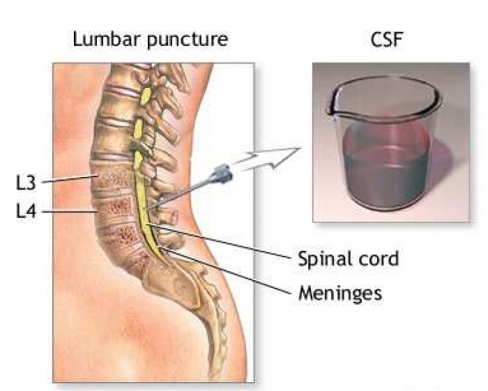 Lumbar puncture What is it?