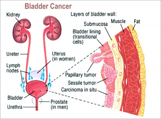 Bladder Cancer Causes, Signs And Symptoms