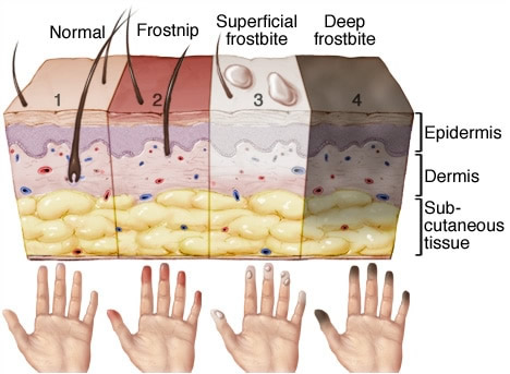 frosbite step