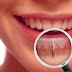 Cấy ghép răng implant hết bao nhiêu tiền ?