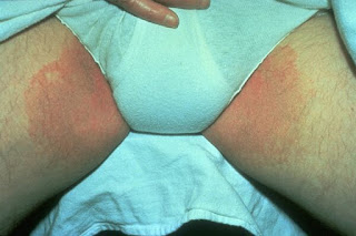 Foto obat salep gatal di bonkong atau pantat di apotik