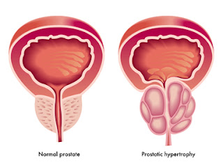  Prostat adalah sebuah kelenjar kecil kira Gangguan Prostat