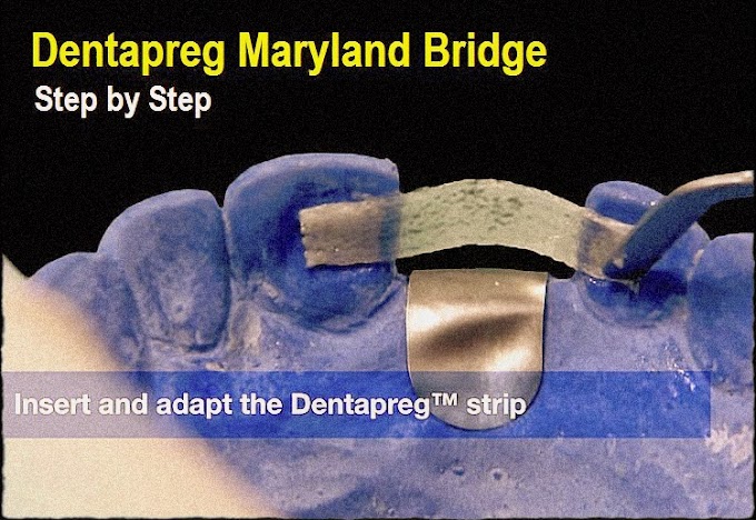 DENTAPREG Maryland Bridge - Step by Step