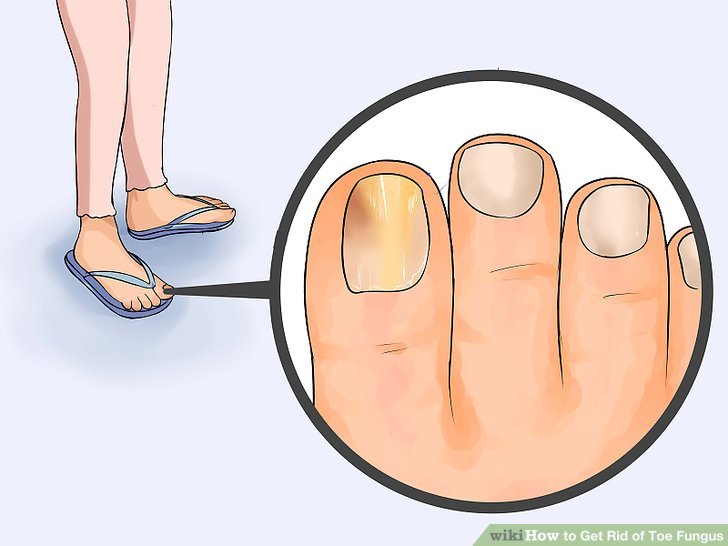 Best Ways To Get Rid Of Toe Fungus