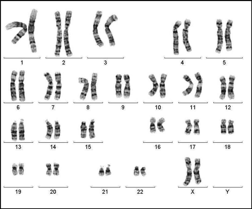 Xxy хромосома. Синдром Клайнфельтера кариотип. Хромосомы при синдроме Клайнфельтера. Синдром Клайнфельтера кариограмма. Синдром Клайнфельтера набор хромосом.