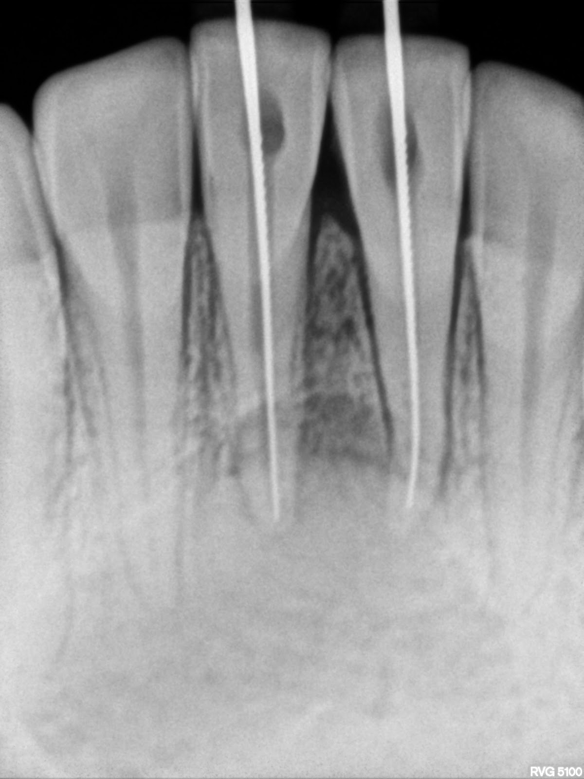 Endodontics Length of master cone determiantion