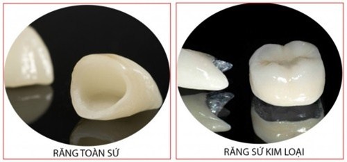 YẾU TỐ ẢNH HƯỞNG ĐẾN THỜI GIAN SỬ DỤNG CỦA RĂNG SỨ -5