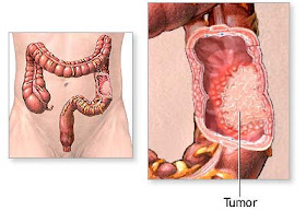 http://arumherbal30.blogspot.co.id/2017/12/cara-alami-menyembuhkan-tumor-pada-usus_4.html