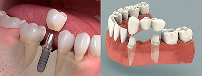 có nên cắm ghép răng implant không -5 có nên cắm ghép răng implant không -5