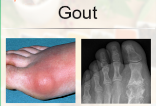 Ayurvedic medicines for gout