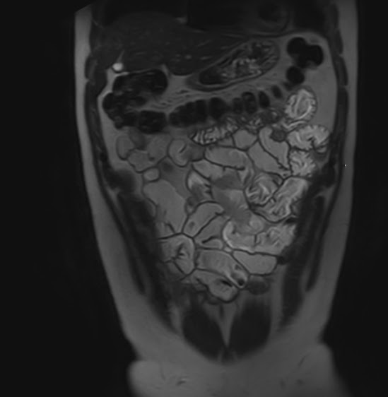 MR Enterography Crohn's Disease Sumer's Radiology Blog