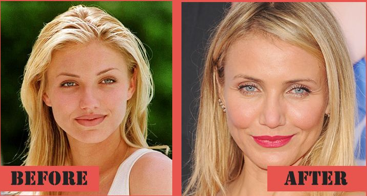 Cameron Diaz Plastic Surgery Before and After | Kim Zolciak Plastic Surgery