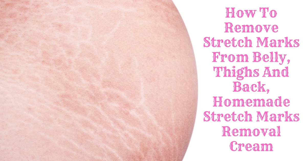How To Remove Stretch Marks From Belly, Thighs And Back, Homemade
