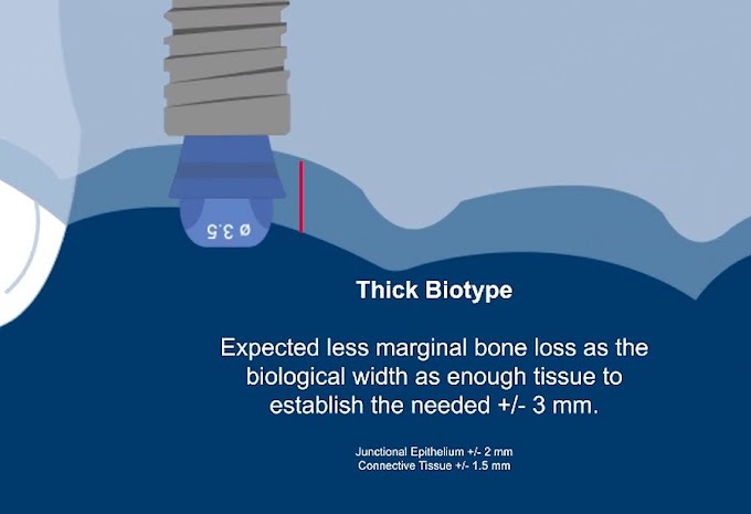 IMPLANTOLOGY: Thick biotype marginal bone loss