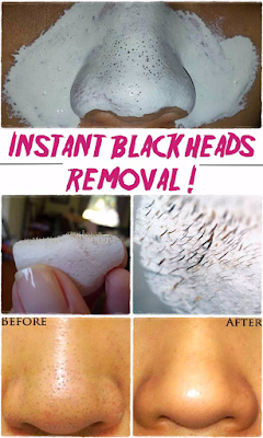 Say goodbye blackheads in 15 minutes !