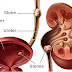 Kidney stones and its effects on Human body - By Science Tutor