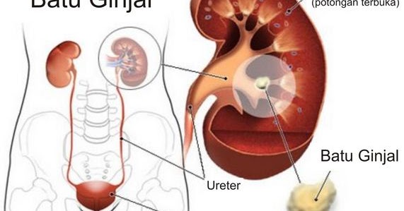 7 Penyakit pada Sistem Ekskresi Ginjal | Berpendidikan