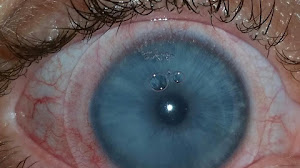 A Keratoconus Patient Struggles with Scleral Lenses