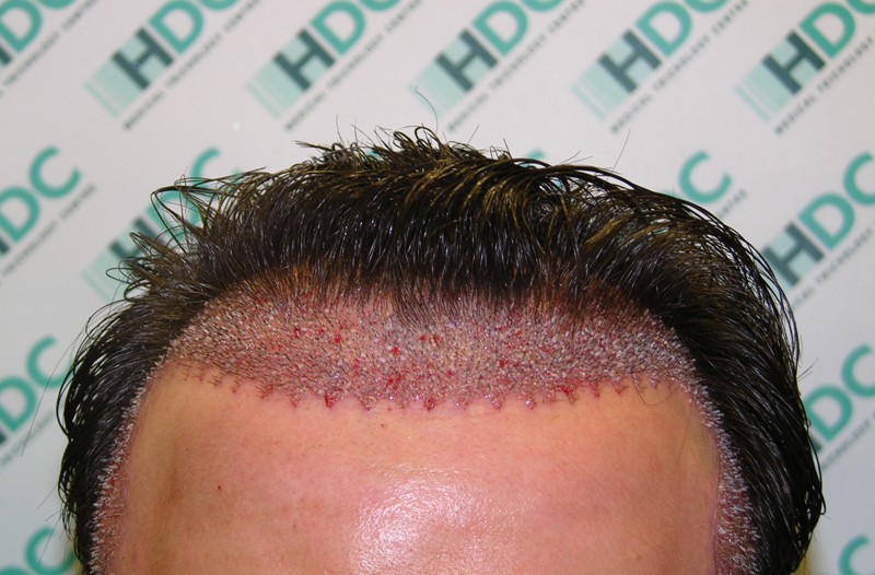 Baldness Treatment Oil And T Hair Natural Baldness Treatment Oil And T