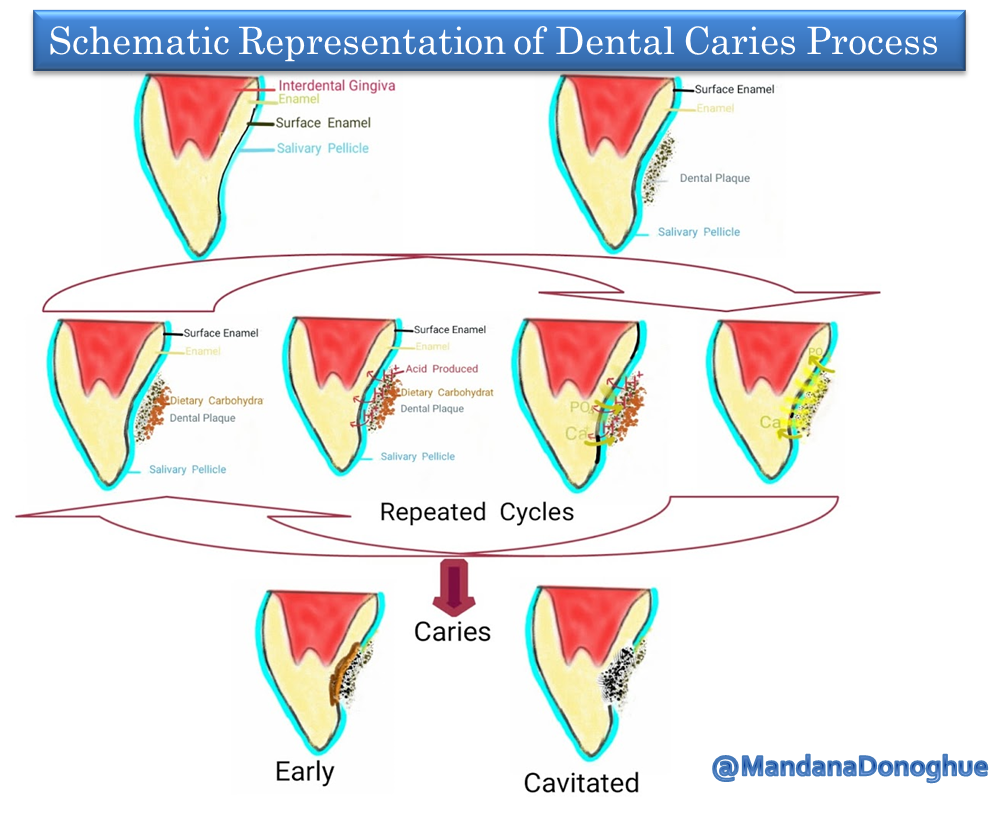 Oral Pathology India CARIES VS. EROSION