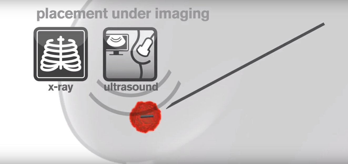 Ob/Gyn Updated Magseed, a minimally invasive breast marker for cancer