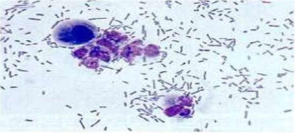 Hasil Tes Urine Bakteri Positif