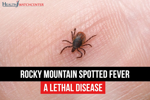 Deadly Rocky Mountain spotted fever, a tick-borne disease on the rise inTennessee after death of 20  Rocky-mountain-spotted-fever-A-lethal-disease-1024x683