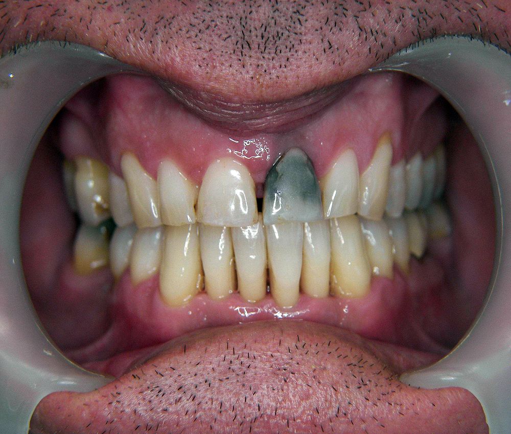 Blanqueamiento Dental Interno