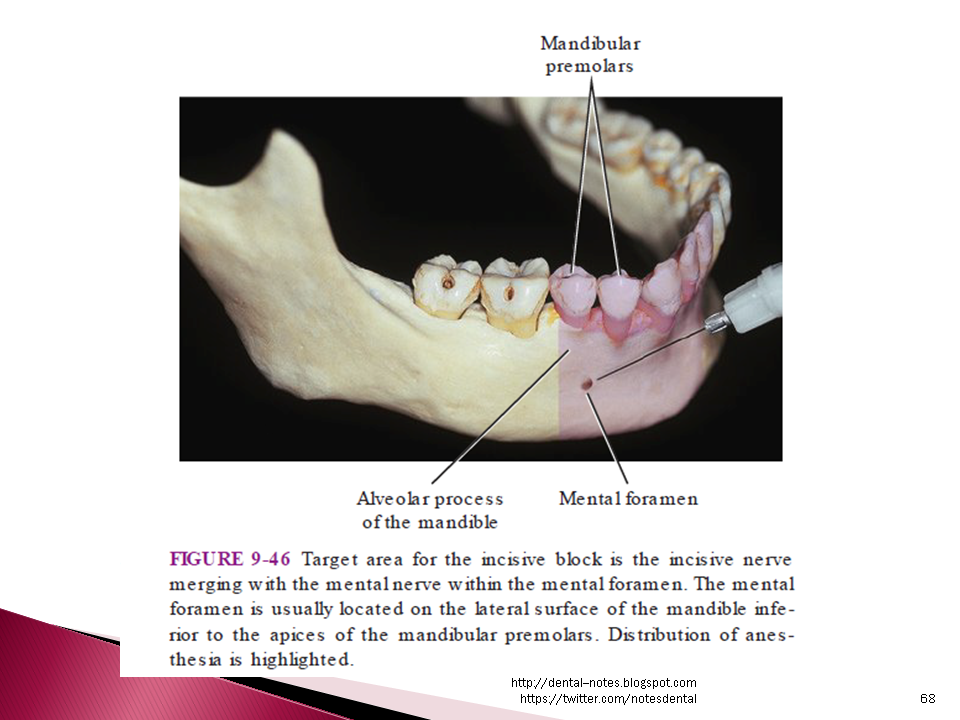 Upper Tooth Nerve Block