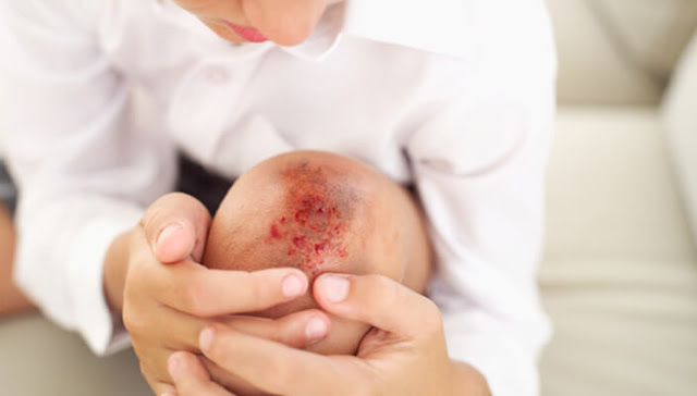 How to Heal Minor Wounds at Home - Home Remedies How to Heal Minor Wounds at Home - Home Remedies