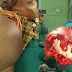Lelaki ini dikurung kerana disangka dirasuk hantu, rupa-rupanya ada tumor sebesar buah tembikai di perutnya