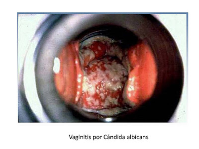 Vaginitis por cándida albicans
