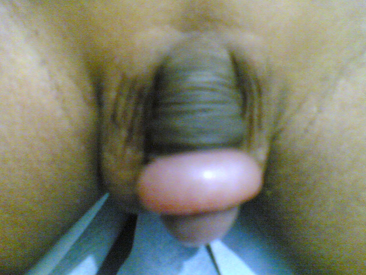   Paraphimosis Paraphimosis is a condition in which the foreskin once pulled back behind the glans cannot be brought down to the original position. It is an uncommon condition and occurs less often than Phimosis. It is serious condition which can happen in men and boys who have not undergone circumcision. It causes painful swelling of the retracted for skin foreskin of the penis.  Causes of paraphimosis • It can occur after retraction of the foreskin for long hours during penile examination, cleaning, urethral catheterization or cystoscopy • It can also occur during penile ring piercing. • It can also occur secondary to erections. • Infection due to poor personal hygiene. • Trauma to the area.  Signs and symptoms of paraphimosis • Penile pain. • Enlargement of glans penis. • Congested with collar of oedematous foreskin • In children it can cause urinary obstruction.  Treatment of paraphimosis • Pressing on (compression of) the head of penis while pushing the foreskin forward may reduce the swelling due to Paraphimosis. If it fails, surgical circumcision will be needed. • Injection of hyaluronidase in to the oedematous prepuce is effective in reducing the oedema and allowing the fore skin to get reduced. • Surgery  Complications of Paraphimosis • Damage to the penis tip. • Gangrene. • Amputation of the penis tip. • Recurrence of Paraphimosis is common. It is prevented by doing circumcision.