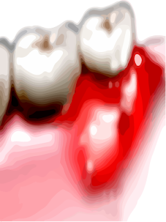 Tooth Abscess or Dental Abscess and Gum Abscess or periodontal Abscess