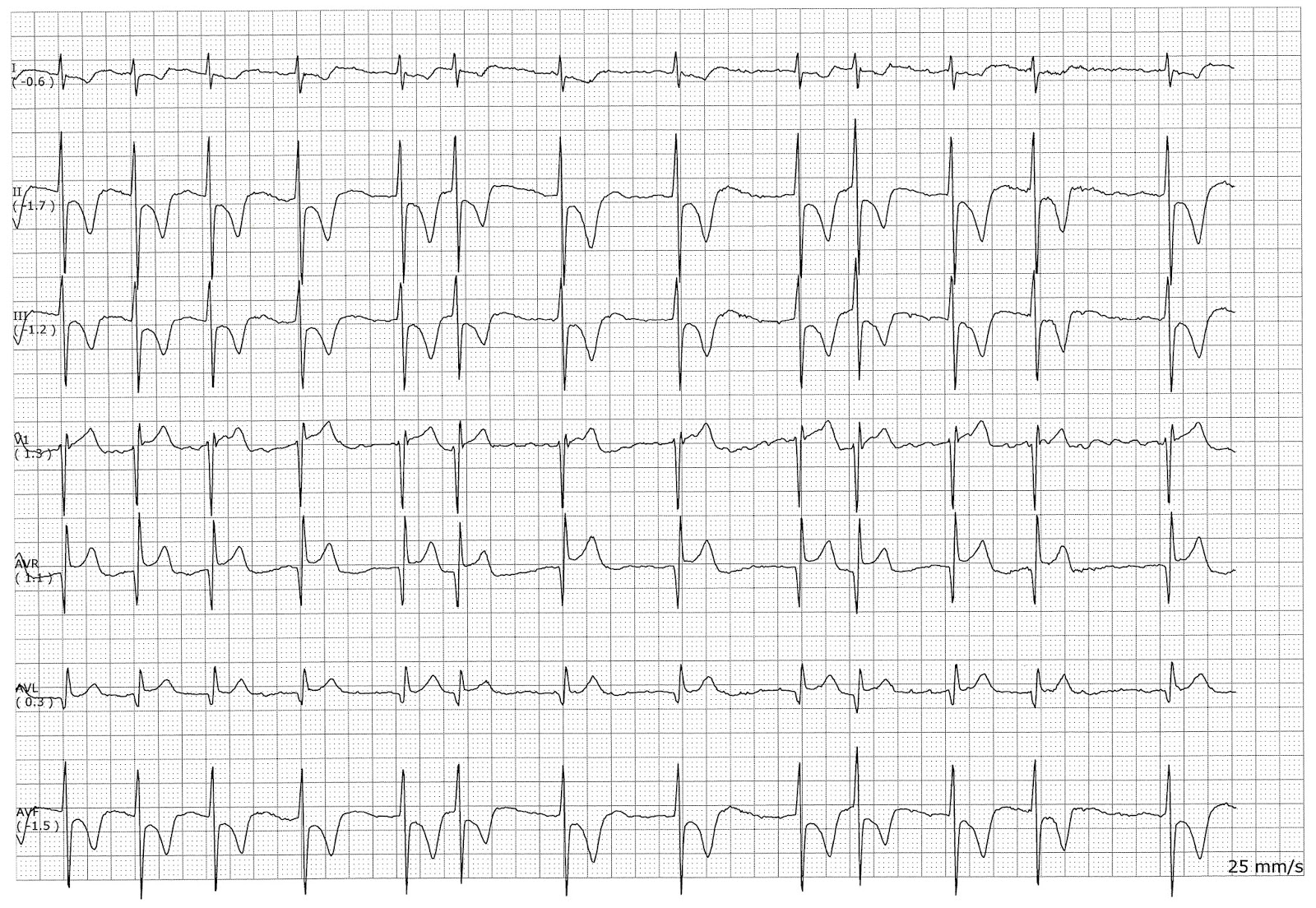 Float Nurse: Atrial Fibrillaion