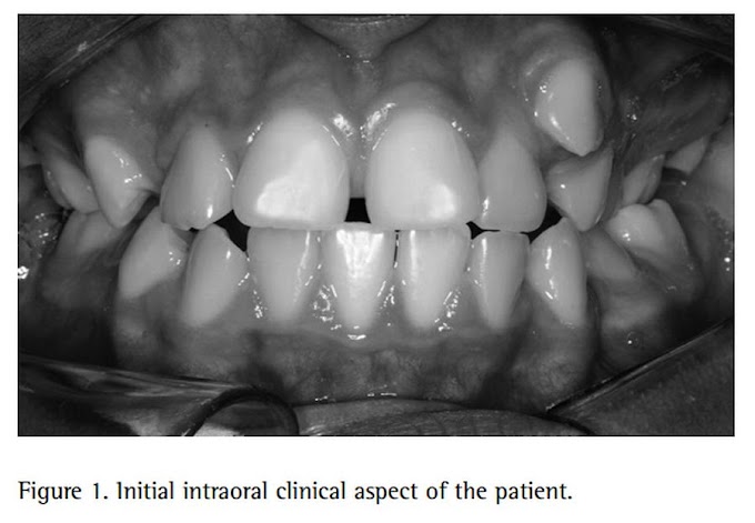 PDF: MULTIPLE SUPERNUMERARY TEETH in a Nonsyndromic 12-Year-Old Female Patient - A Case Report