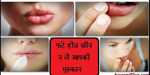 फटे होंठ छीन न लें आपकी मुस्‍कान ! इन आसन तरीकों से अपने होंठ बनाये खूबसूरत !