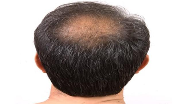 गंजी खोपड़ी पर बाल उगाने है - तो अपनाए यह तरीका - Get rid of baldness गंजी खोपड़ी पर बाल उगाने है - तो अपनाए यह तरीका - Get rid of baldness