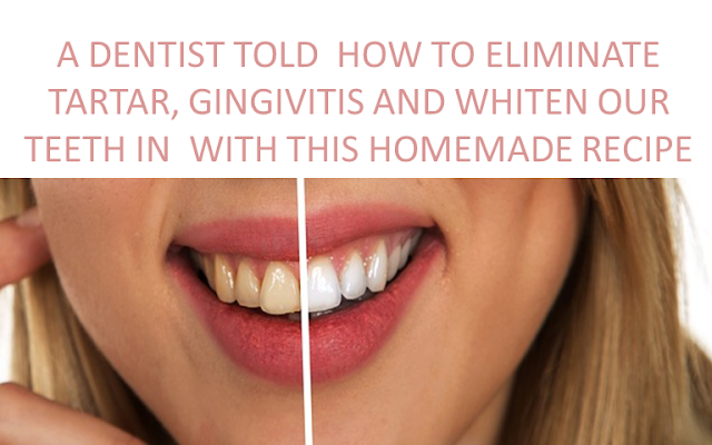 A DENTIST TOLD  HOW TO ELIMINATE TARTAR, GINGIVITIS AND WHITEN OUR TEETH IN  WITH THIS HOMEMADE RECIPE