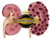 Memakan Mie Terlalu Banyak Bisa Gagal Ginjal Memakan Mie Terlalu Banyak Bisa Gagal Ginjal