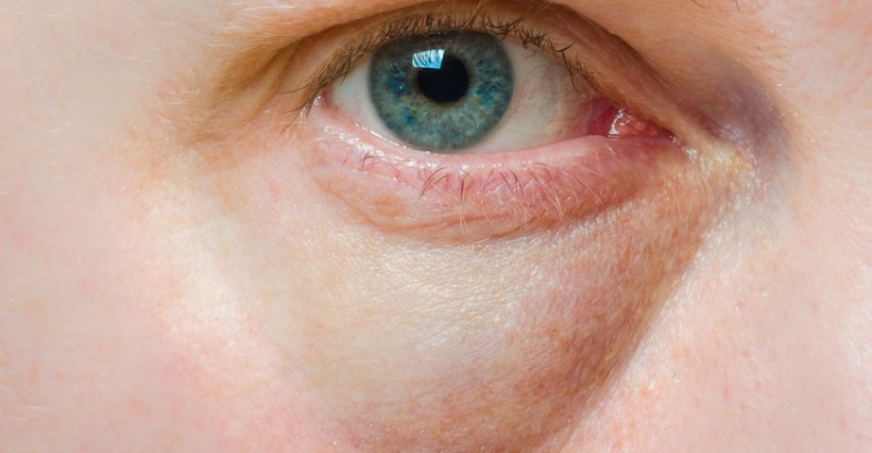 114 Best Cara Menghilangkan Garis Halus Di Bawah Mata Secara Alami Last Update 2021 114 Best Cara Menghilangkan Garis Halus Di Bawah Mata Secara Alami Last Update 2021