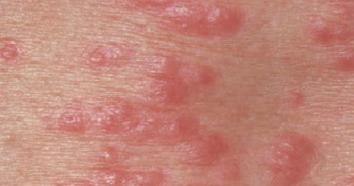 40 macam jenis penyakit kulit dan penyebabnya