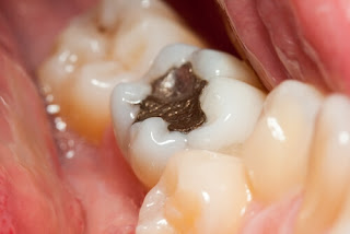  Trám răng có hết sâu răng không?