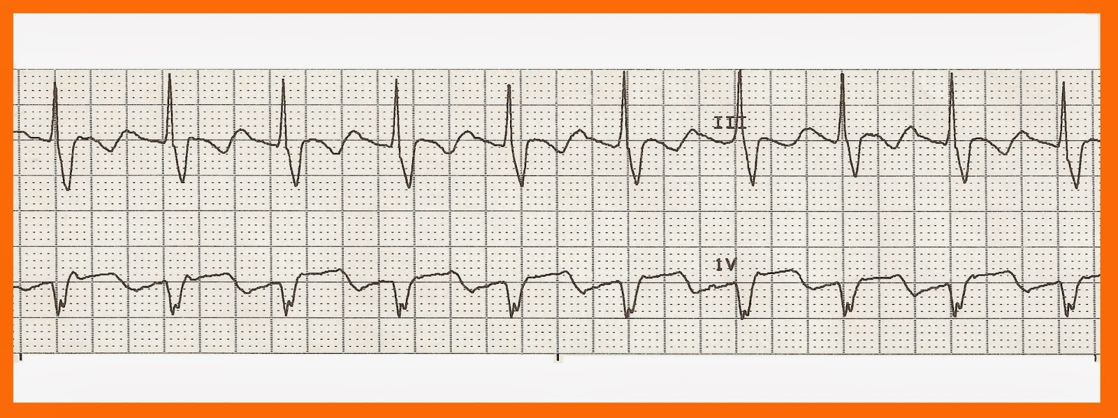 Practice EKG Rhythm Strips 211