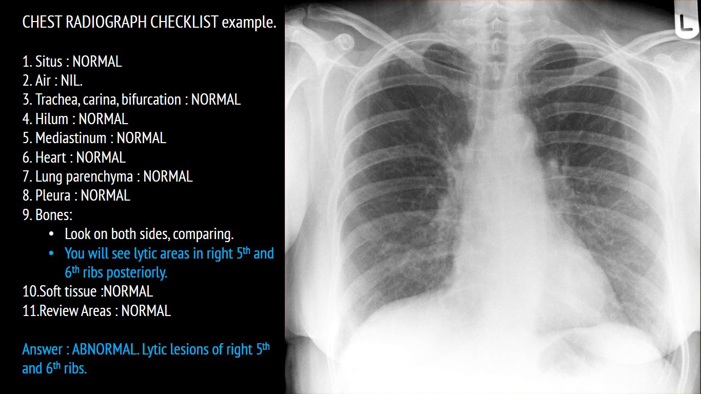 How To Check Chest X Ray Report
