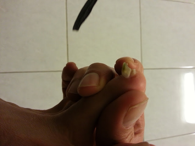 Ugly black toes Clearance