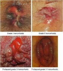 wasir obat herbal wasir